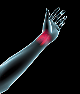Wrist Pain is one of the most common symptoms of CTS.”