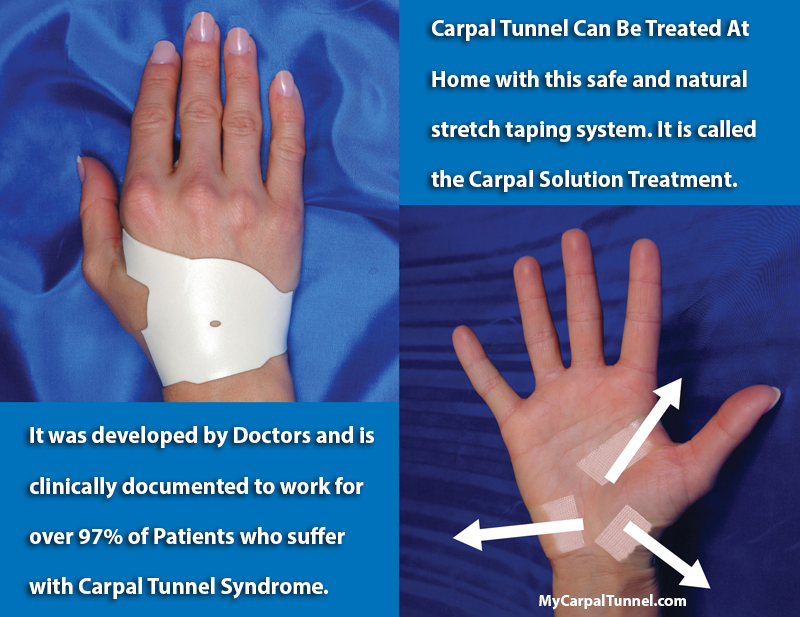 carpal tunnel can be treated at home with this safe and natural stretch taping system