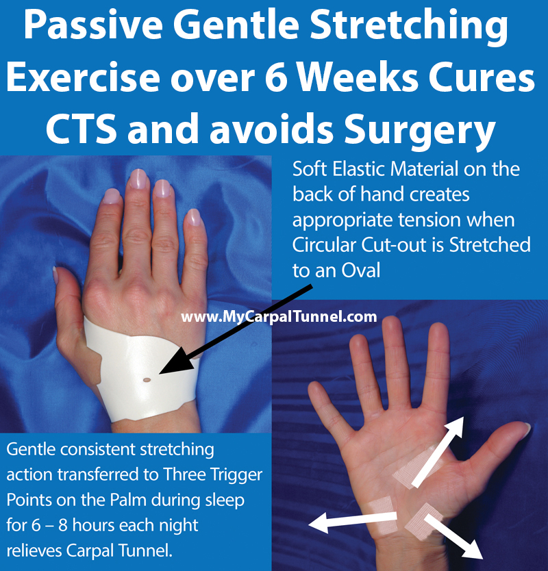 Passive Gentle Stretching Exercise for 220 Hours over 6 Weeks Cures CTS and avoids Surgery