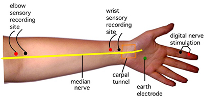 Nerve-Conductivity-Study-positions-on-hand-wrist-fingers-arm