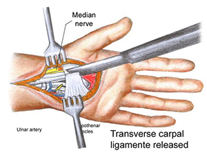 Sometimes the transverse carpal ligament grows back together with less space than before carpal tunnel surgery due to the formation of scar tissue. 