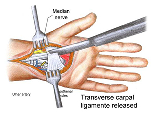 Transverse-Carpal-Ligament-Severed-and-Released Sometimes the transverse carpal ligament grows back together with less space than before carpal tunnel surgery due to the formation of scar tissue.