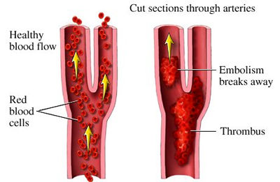 dangerous blood clots caused by carpal tunnel surgery