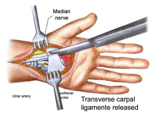 carpal tunnel surgery video