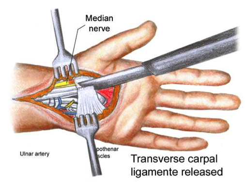 for a repetitive strain injury like CTS, repeating high-risk invasive surgery for the same ailment is a poor protocol at best