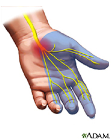 hand pain due to carpal tunnel