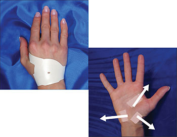 The Carpal Solution gently tugs simultaneously at three key points on the palm surrounding the carpal tunnel during sleep.