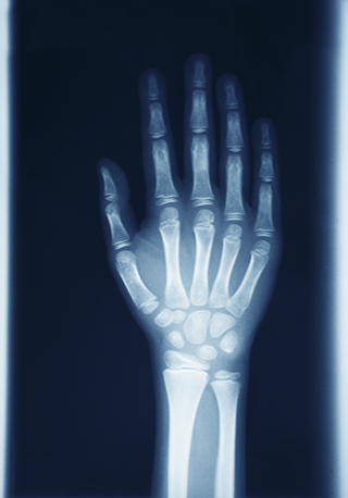There are 27 bones in the hand and wrist all nested together in a unique way to allow the remarkable dexterity we enjoy with our hands and wrists. We take it for granted until something goes wrong.