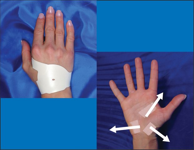 carpal tunnel treatment for right hand