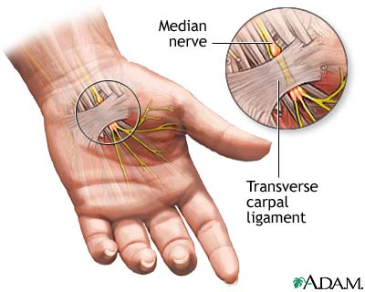 numb hands and tingling hands are signs of carpal tunnel