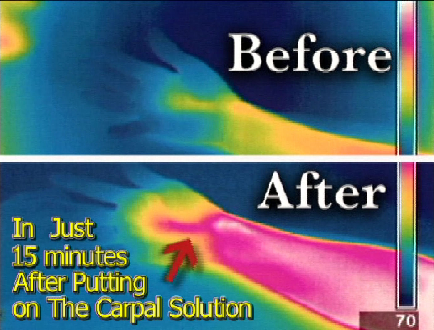 thermal imaging picture shows how the carpal solution increases blood circulation after wearing it for only 15 mintues