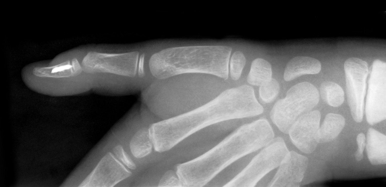 xray of Arthritis