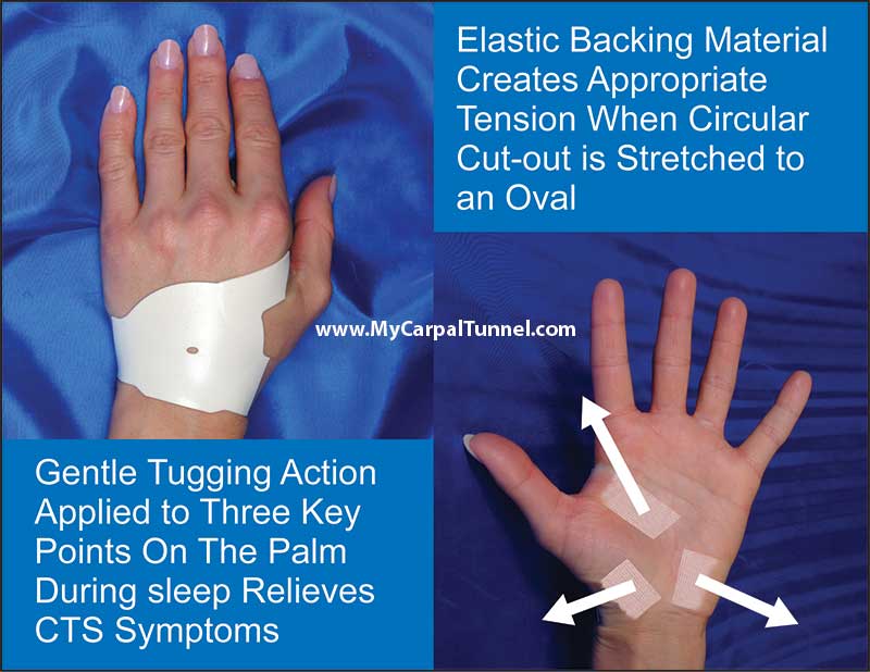 Gentle decompression of soft tissue during sleep combined with active use during the day results in an ideal rhythmic therapy for relief from CTS symptoms