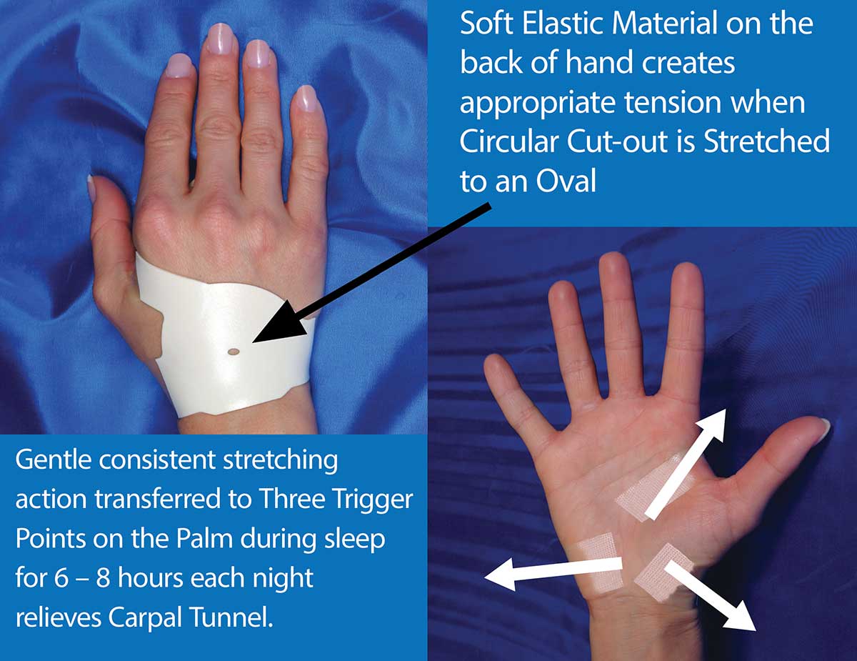 gentle consistent stretching action transferred to three trigger points in the palm each night relieves carpal tunnel pain 