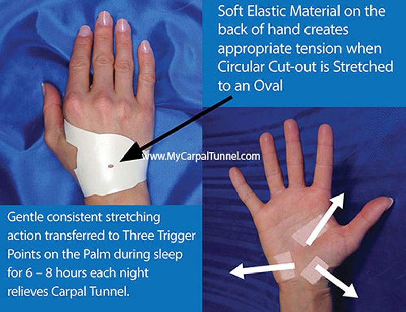 nighttime-streching-carpal-tunnel-cure The Carpal Solution represents a new kind of wrist orthosis device that is a big improvement over the rigid restrictive splints
