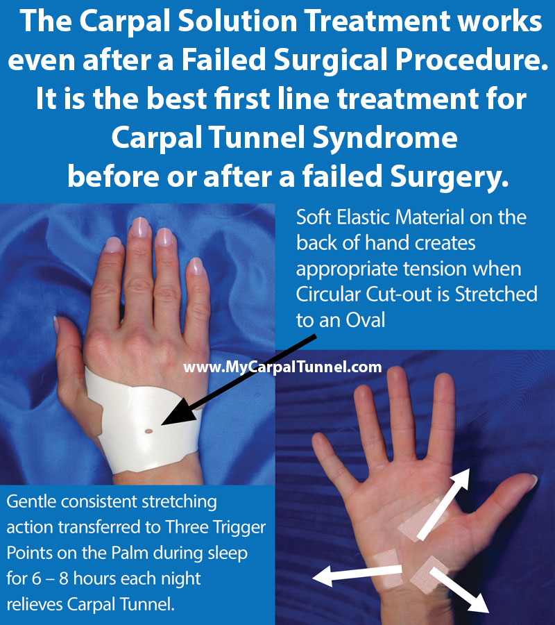 The Carpal Solution Treatment works even after a Failed Surgical Procedure