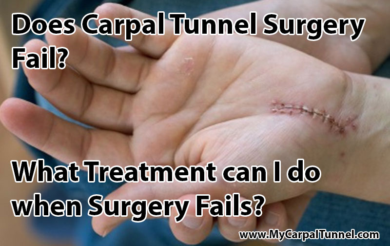 does-carpal-tunnel-surgery-fail What Treatment can I do when Surgery Fails