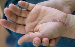 pain worse after carpal tunnel surgery