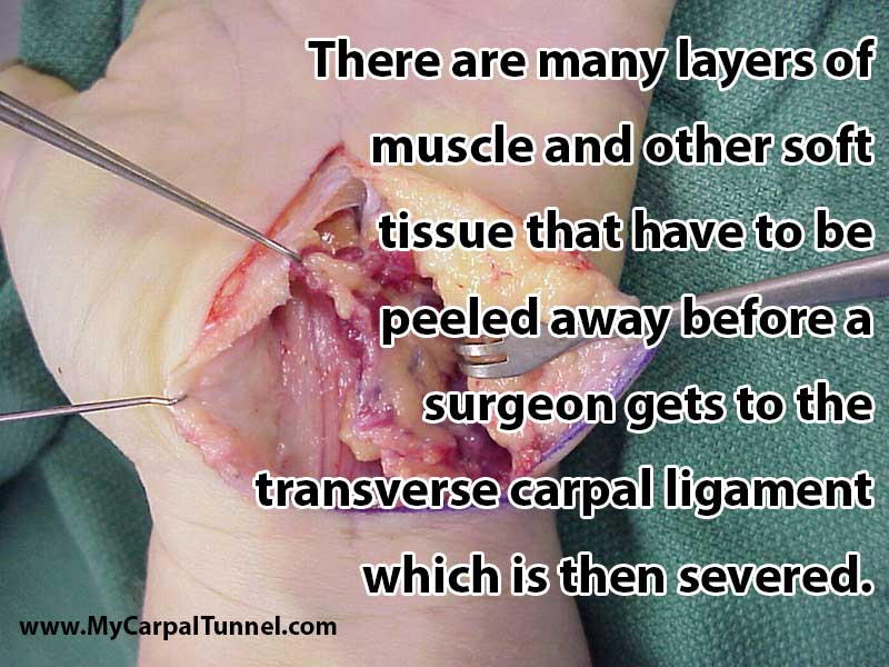 carpal-tunnel-surgery-results-in-scar-tissue-complications There are many layers of muscle and other soft tissue that have to be peeled away before a surgeon gets to the transverse carpal ligament which is then severed.