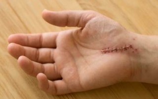 scar tissue and carpal tunnel surgery