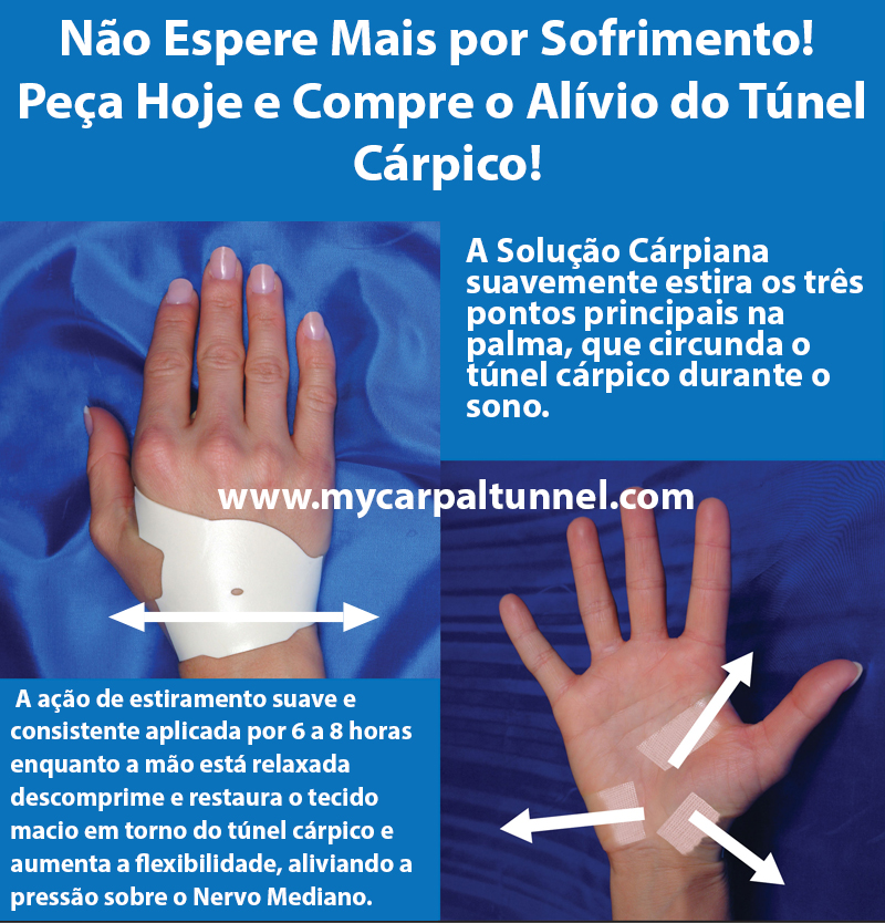 A-Solucao-Carpiana aliviando a pressão sobre o Nervo Mediano
