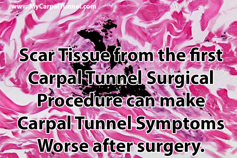 scar-tissue-carpal-tunnel-pain-worse Scar Tissue from the first Carpal Tunnel Surgical Procedure can make Carpal Tunnel Symptoms Worse after surgery.