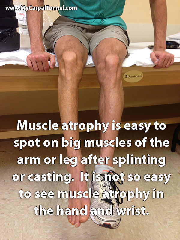 It is not so easy to see muscle atrophy in the hand and wrist