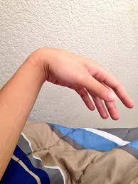 curling-wrist-at-right-angle-makes-carpal-tunnel-symptoms-worse People with Carpal Tunnel should avoid holding their wrist at a right angle during sleep