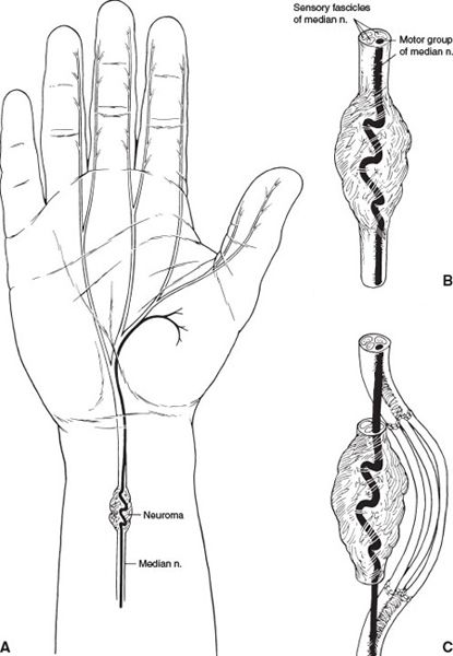 Neuroma mycarpaltunnel in forearm complication from carpal tunnel surgery