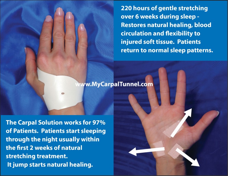 The Carpal Solution jump starts natural healing