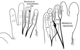 neuroma from carpal tunnel surgery finger amputation or in the foot can be painful