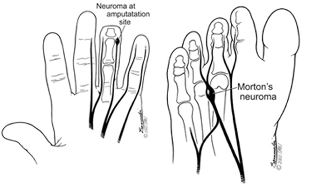 neuroma from carpal tunnel surgery finger amputation or in the foot can be painful