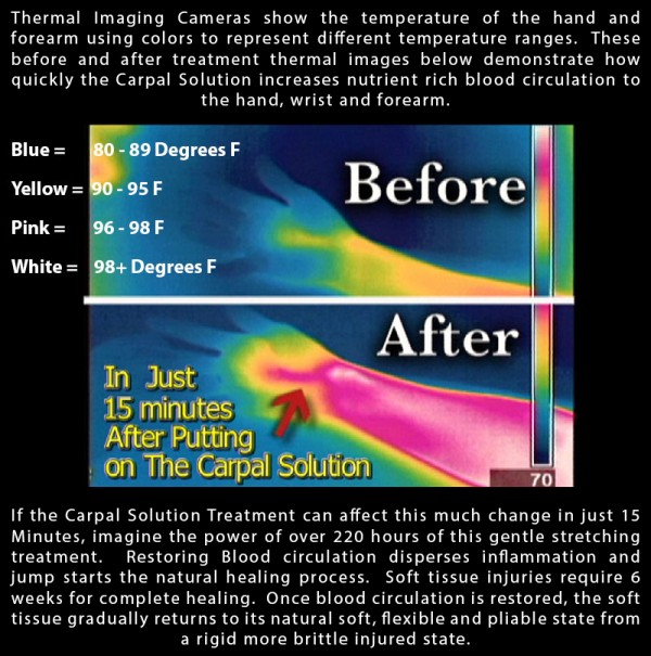 thermal-imaging-demonstrates-return-of-blood-circulation-Carpal-Solution-Treatment thermal imaging demonstrates return of blood circulation Carpal Solution Treatment