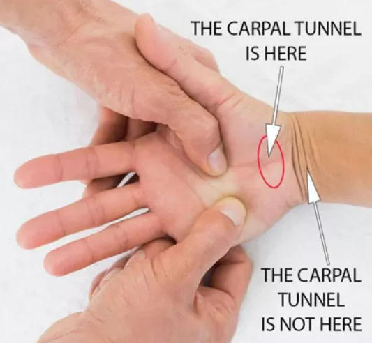 Where is the Carpal Tunnel Anatomically. It is at the base of the hand. Carpal Tunnel is not in the wrist as many people think.  This is how the Carpal Solution works stretching open soft tissue at the based of the hand