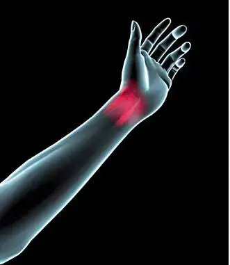 Wrist Pain Carpal Tunnel Arthritis Gout Treatment