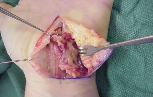 Video Of Carpal Tunnel Surgery 1 carpal tunnel surgery is not a permanent fix for carpal tunnel syndrome. Natural treatment should be tried first.