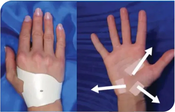 How to Apply The Carpal Solution Treatment 1 How To Apply The Carpal Solution