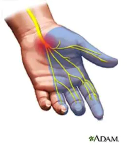 What is Carpal Tunnel? 6 hand pain