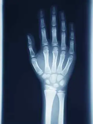 x ray hand wrist carpal tunnel treatment 27 bones in hand