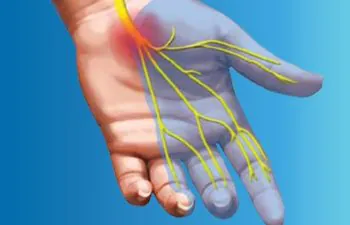 1 Carpal Tunnel Synddrome Median Nerve Path of pain numbness