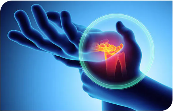 Carpal Tunnel Syndrome Treatment – Clinical Study 1 Hand pain and permanent nerve damage with carpal tunnel