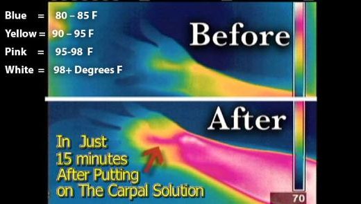 Trapped Inflammation from Carpal Tunnel Syndrome restricts blood circulation and blocks natural healing.