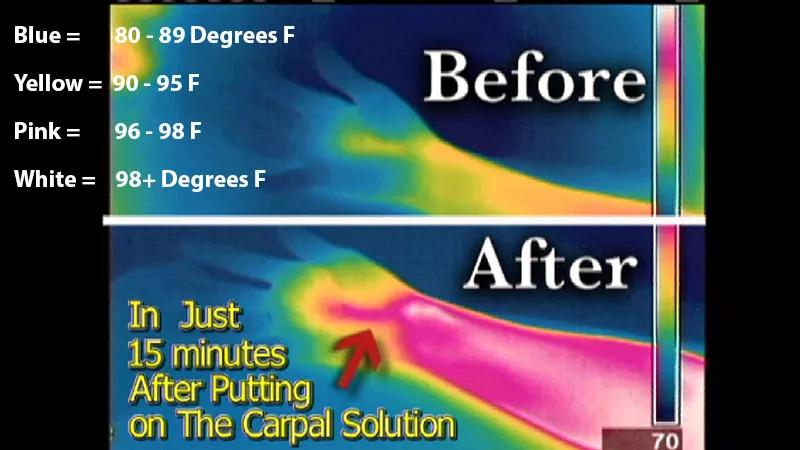 Actually, Doctors have developed a 6 Week Home Treatment Kit that costs only about $100 per hand delivered to your home for treatment at night during sleep. It is called the Carpal Solution Treatment Kit.