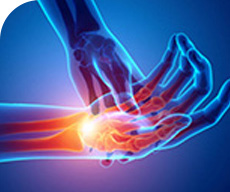 Image showing nerve inflammation in Carpal Tunnel Syndrome