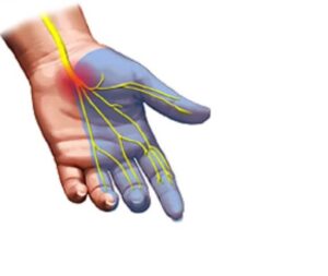 Carpal Tunnel Symptoms are caused by pinching of the Median Nerve in the Carpal Tunnel Space a the base of the palm.