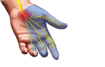 Carpal Tunnel Symptoms are caused by pinching of the Median Nerve in the Carpal Tunnel Space a the base of the palm.