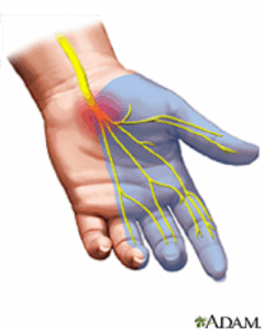 Carpal Tunnel Syndrome