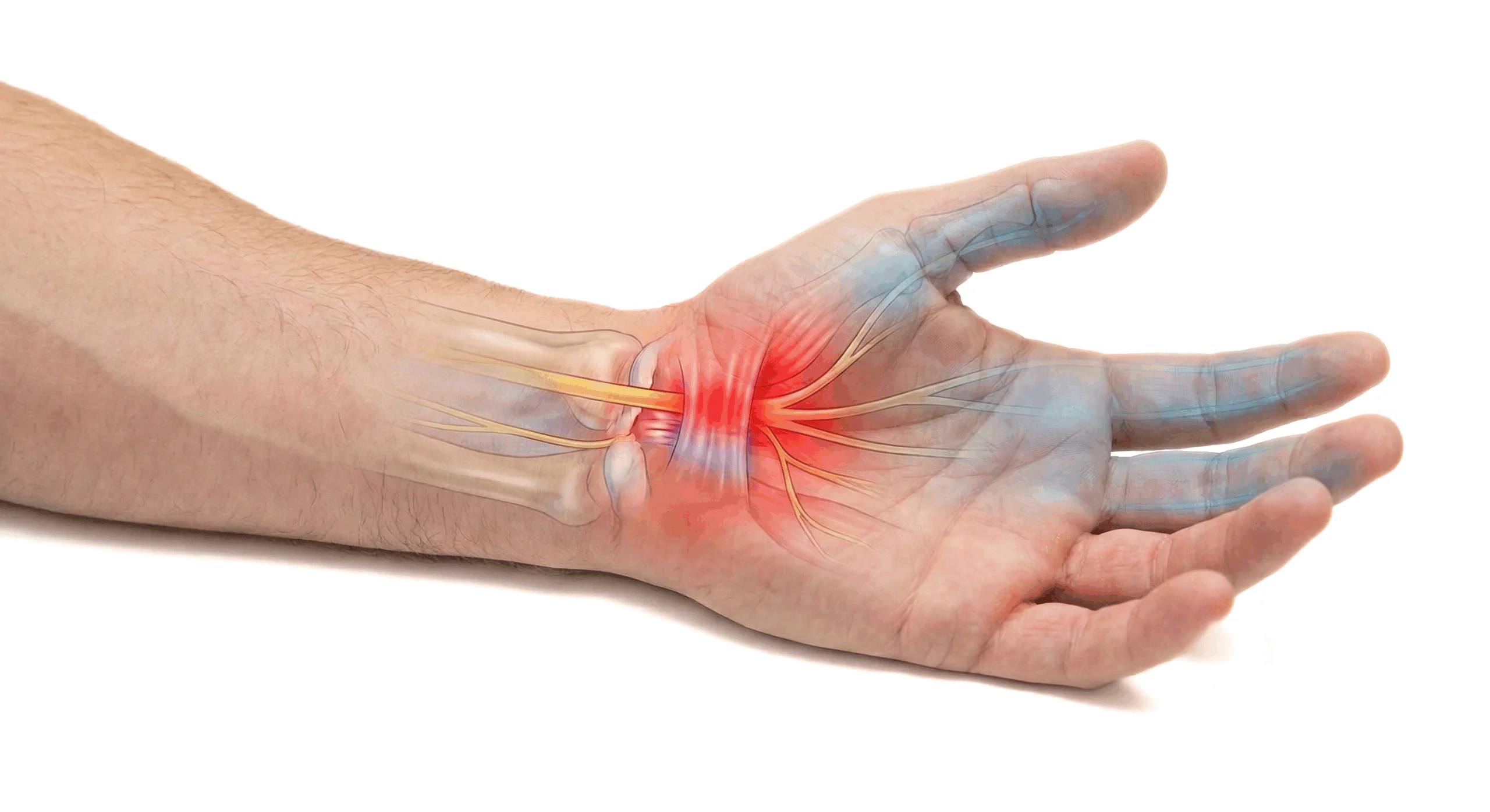 How The Carpal Solution Works. Gentle consistent passive stretching therapy during sleep for 6 weeks opens up lymph channels and restores full blood circulation and jump-starts natural healing path ways. Drains Lymph fluid and removes pressure from median nerve- the root cause of Carpal Tunnel Syndrome is trapped inflammation.