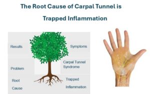 Understand The Root Cause of Carpal Tunnel so you can treat it in the best way possible. The Root Cause is Trapped Inflammation.