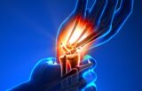 Permanent Nerve Damage and Carpal Tunnel Syndrome takes years of neglect.